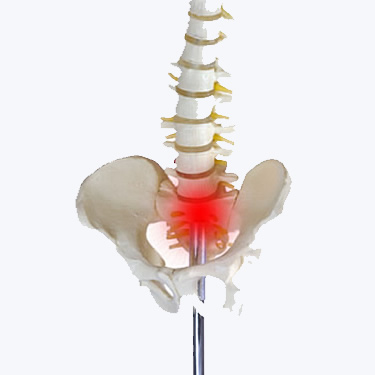 squelette, sciatique, névralgie